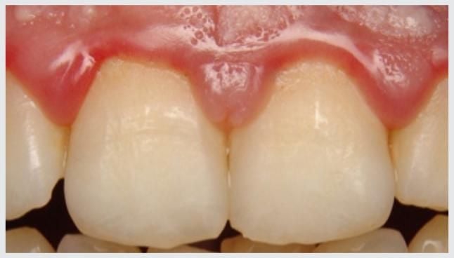bolsa_periodontal_25kb-640540a6 Meu implante dentário caiu!