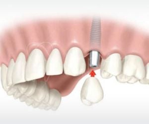 65709535 All on 4 Implants in Brazil: affordable Smiles