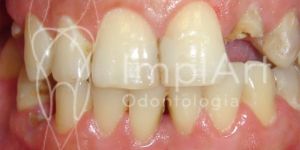 6716639a Dúvidas sobre prótese dentária protocolo sob implante dental