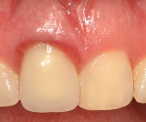 dente_inflamado-670e0c51 Coroa de zircônia pura para implantes