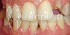 fratura_dental_o_que_fazer_50kb-6716639a Implante total: quais os tipos de próteses e quais suas diferenças?