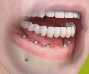 6a44678c Rejeição de implante dentário: pode ocorrer?