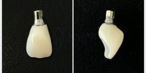 6a5bf891 Estética dental com prótese dentária e coroas em porcelana - Metal free