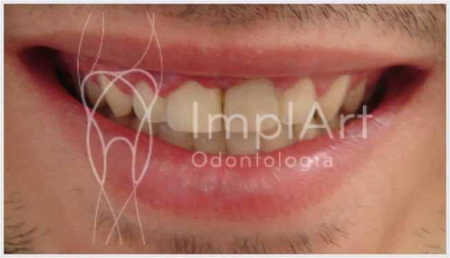 6bb128f9 Gengivite e Inflamação na gengiva: prevenção, sinais, sintomas e tratamento