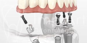 6c0d5e33 Depois de um tratamento de canal deve-se fazer restauração ou núcleo e coroa de porcelana?