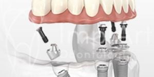 Carga_imediata_All_on_4_50kb-6c0d5e33 Pessoas com diabetes podem fazer implante dentário?