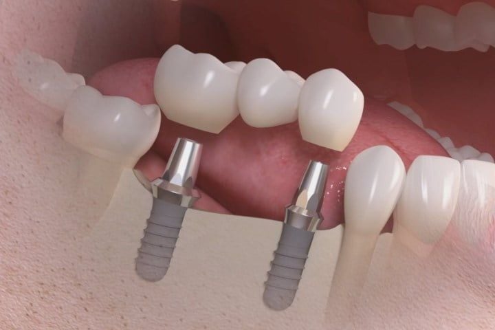 6eb33aa8 Restaurando Sorrisos com Precisão: Implante Dentário Parcial na Clínica ImplArt