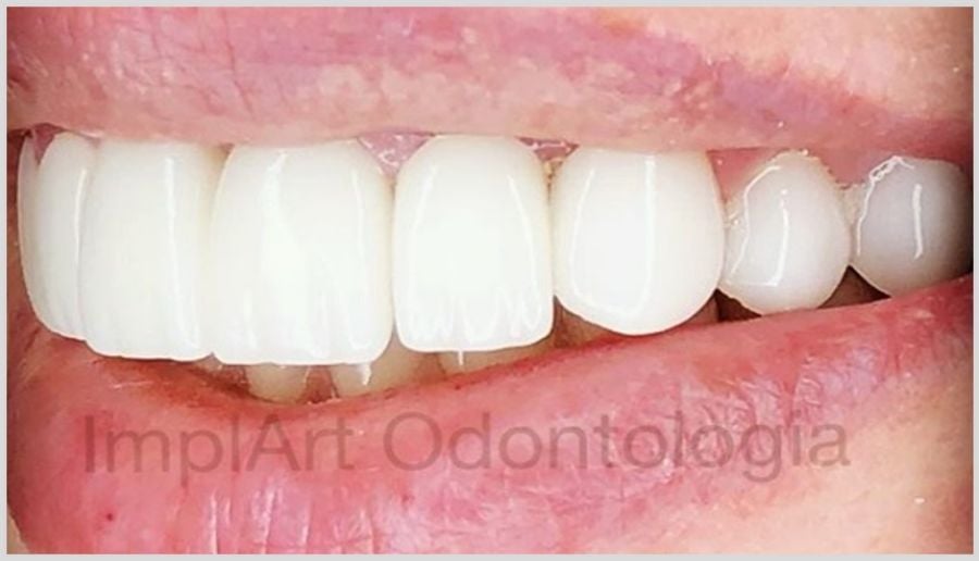 7095ff39 Quanto tempo dura a lente de contato dental