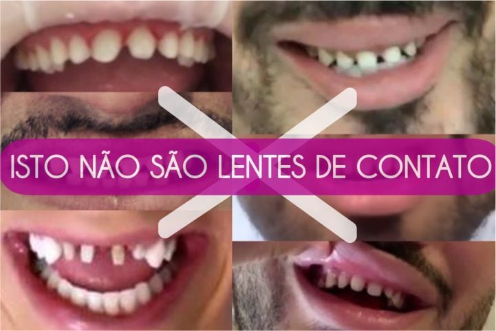 70b7736b Dentes de tubarão: imagens divulgadas na internet como lentes dentais, mas não são.