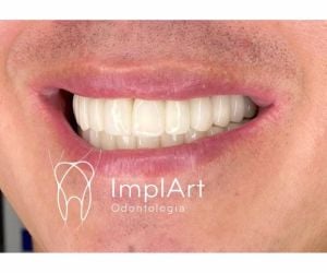 74557bb6 Extração de um dente infeccionado e implante em seguida: é possível?