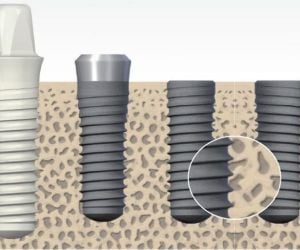 7646fcd9 Recuperação de um implante dentário: quanto tempo?