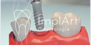 76fd75c4 Fumar pode prejudicar os implantes dentários