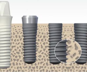 osseointegracao_de_implante_50kb-7646fcd9 Dente mole: o que é, porque acontece, tratamentos e soluções possíveis