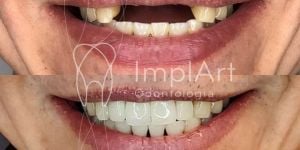 777e8ec4 As vantagens dos implantes dentários