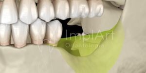 79b9adba Prótese dentária fixa de porcelana sobre dentes com ou sem gengiva
