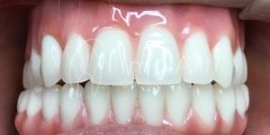 protese_metaloplastica_resina_50kb-794032c1 Carga imediata sem enxerto: sistema all on 4 (all on four) com 4 implantes