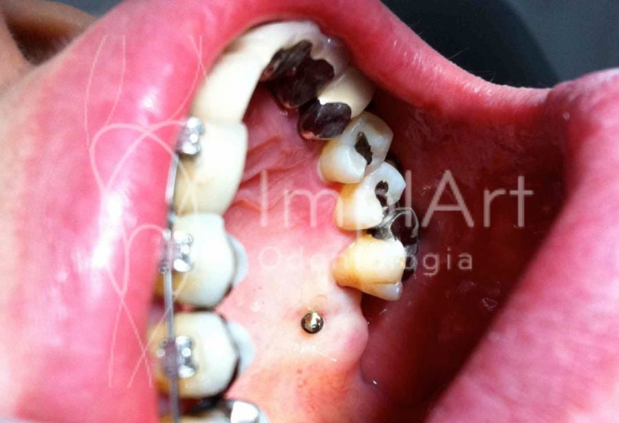 7c8c9b30 Especialista em implantes dentarios - Implantodontista Dr. Roberto Markarian