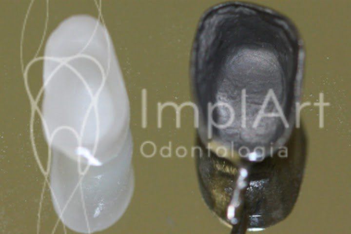 7cac85d1 Por que é preciso colocar um núcleo para fazer coroas após canal?