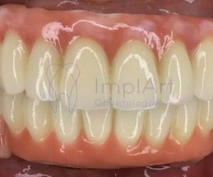 protese_metaloceramica_total_superior_50kb-7de9796e Implante dentário em quem usa aparelho ortodôntico