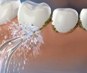 waterpik-e-irrigador-dental-7e22d136 O que fazer quando surge uma cárie dentária?