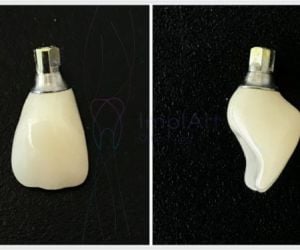 815902fe Quantos implantes dentários são colocados de cada vez?