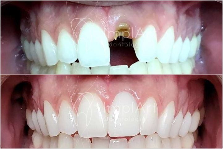 implante_unitario_coroa_metal_free_antes_e_depois_50kb-81af952f Extração de um dente infeccionado e implante em seguida: é possível?