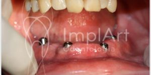 826e756d Carga imediata - Implante dentário mais rápido