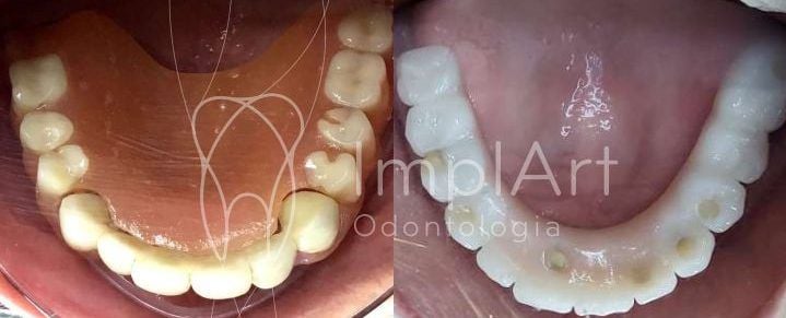 86266cb1 Prótese total sobre implantes com céu da boca livre