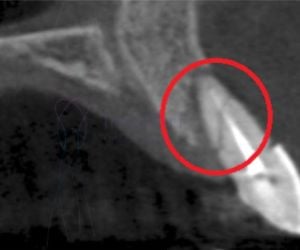 8902be01 Prótese protocolo de resina com estrutura de titânio