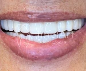 8911e3b6 Por que trocar sua prótese fixa sobre dentes por implante com coroa?