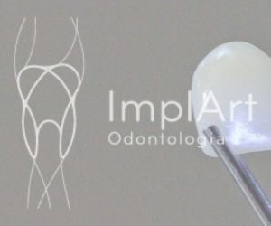 8af38998 O que é enxerto ósseo dentário