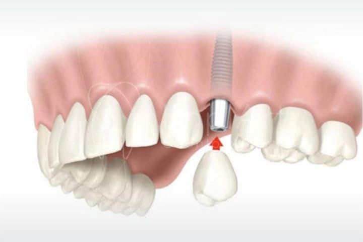 carga_imediata_um_dente_50kb-8bad61d4 Carga imediata - Implante dentário mais rápido