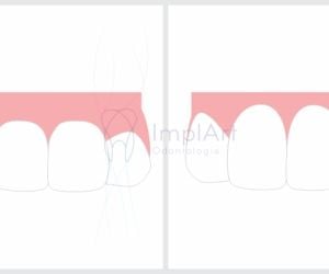 8cdeb65c Cirurgia de implante guiada (fechada) ou cirurgia aberta