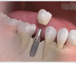 8d2ea311 Recuperação de um implante dentário: quanto tempo?