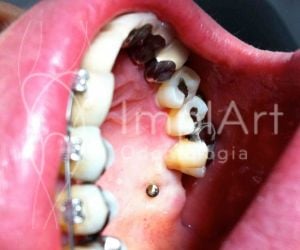 8dc2681b Por que trocar sua prótese fixa sobre dentes por implante com coroa?
