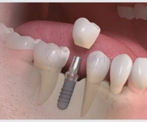 implante_unitario_43kb-8d2ea311 Implante dentário em quem usa aparelho ortodôntico