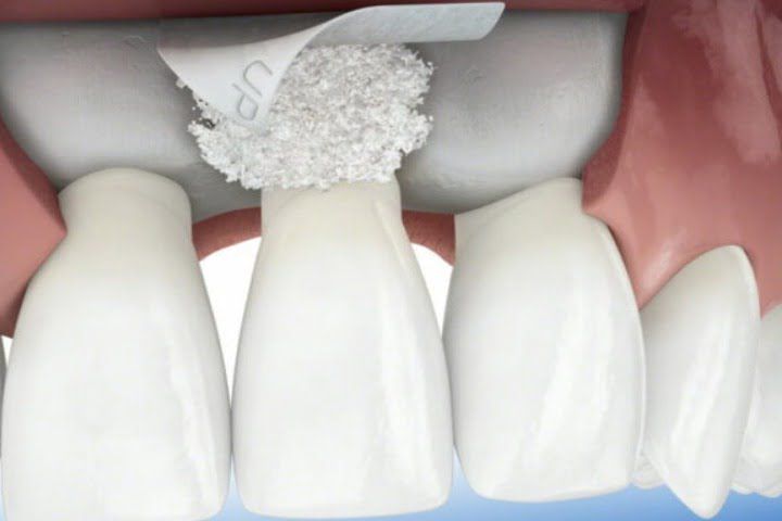 8e50434f Enxerto ósseo para implante dentário: quando fazer?