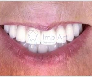 8e605419 Implantes dentários: alimentação e cuidados após a cirurgia