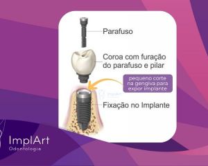 900ae22b Clínica de Implante Dentário e Prótese Dentária ImplArt