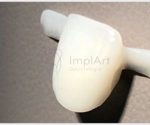 92870a47 Enxerto ósseo biomolecular para implante