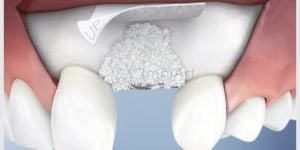 940f2927 Implante dentário: a idade do paciente interfere no sucesso?