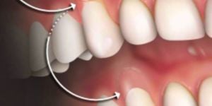 enxerto_de_gengiva_50kb-947dec2b Parestesia depois de uma cirurgia de implante dentário