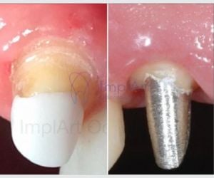 9e71bbfa Implante dentário em quem usa aparelho ortodôntico