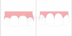 Aumento_coroa_clinica_2-a00f6be6 Implantes All on 6: Solução Completa para o Sorriso com implantes