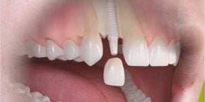 implante_straumann_pure_ceramic_49kb-a03b9805 Desvendando os Mitos sobre Implantes em Idosos