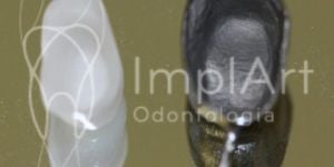 a4b79da0 Reabilitação oral com coroas de porcelana individuais