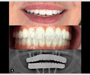 protese_total_zirconia_translucida_monolitica_40kb-a74f2b57 Coroa de zircônia pura para implantes
