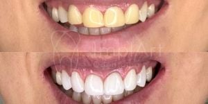 a80a0a93 Prótese fixa sobre implantes superior e inferior