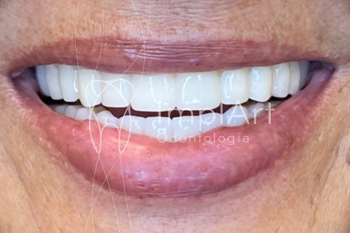 a84f2d57 All on 4 Implants in Brazil: affordable Smiles