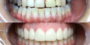 a942426c Fumar pode prejudicar os implantes dentários